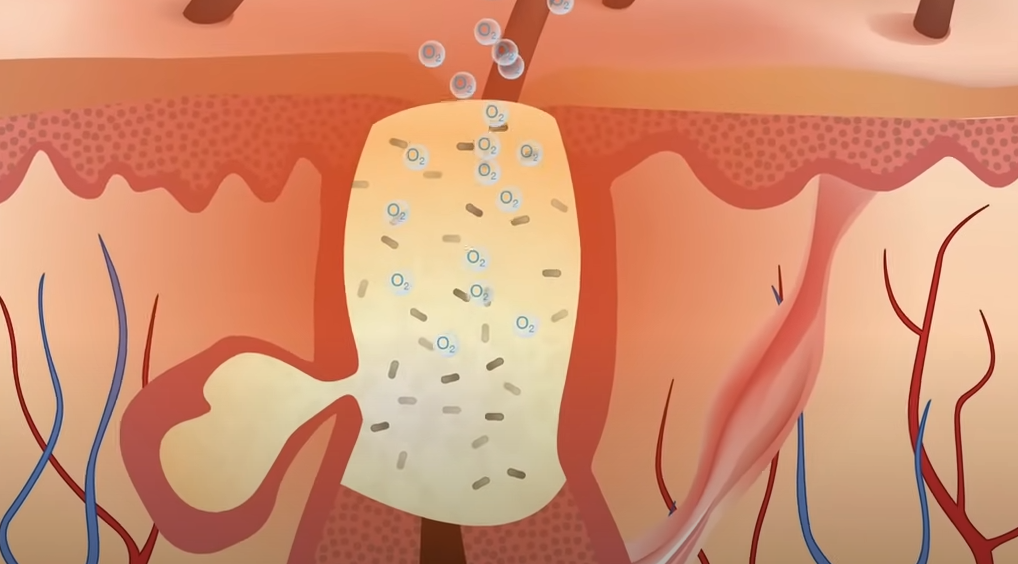 Salicylic Acid Against Acne