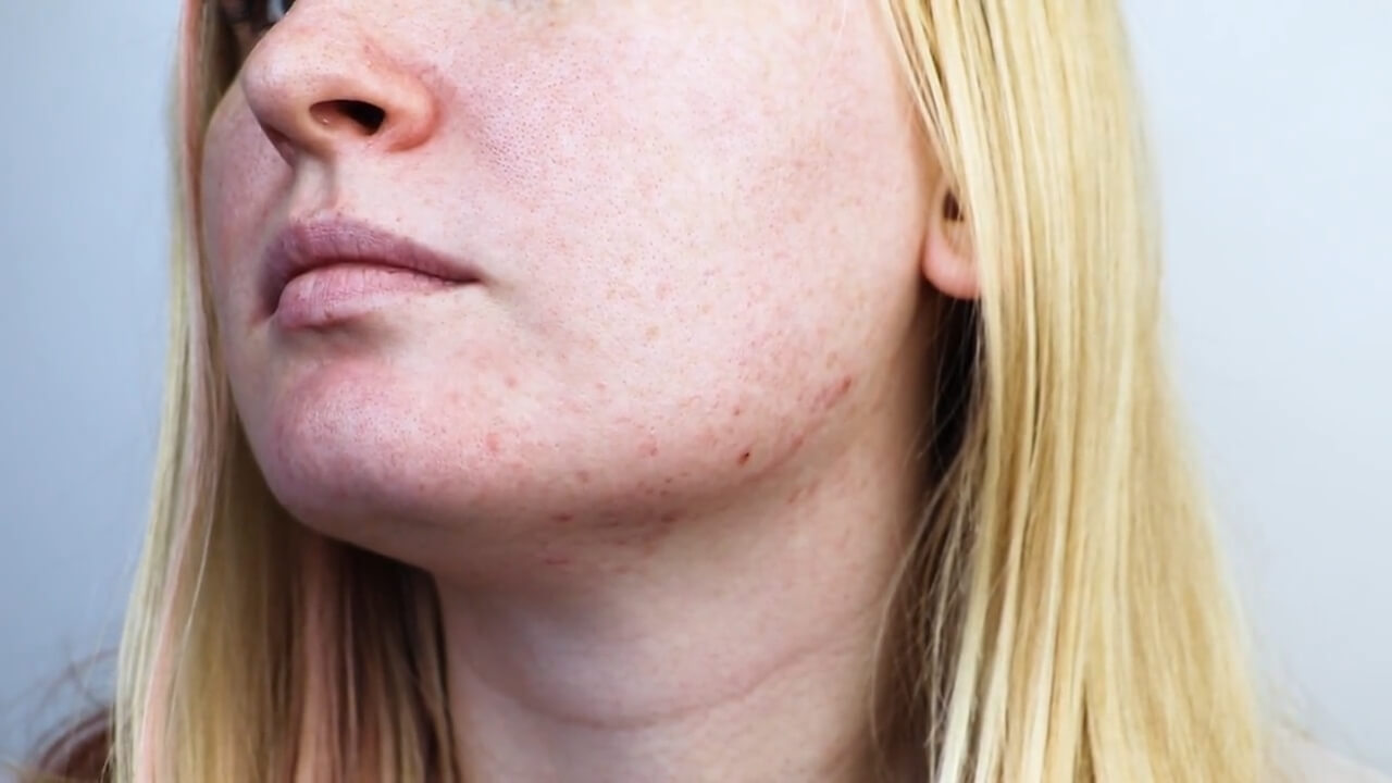 Understanding Accutane Impact on the Body